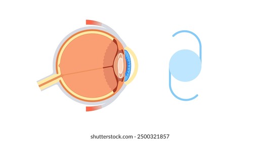 Intraocular lens implantation poster. Cataract treatment, healthy eye with IOL. Nearsightedness or farsightedness. Human visual system anatomy. Cataract surgery anatomical flat vector illustration.