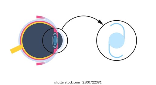 Cartel de implantación de lentes intraoculares. Tratamiento de cataratas, ojo sano con LIO. Visión corta o hipermetropía. Anatomía del sistema visual humano. Ilustración vectorial anatómica de cataratas.