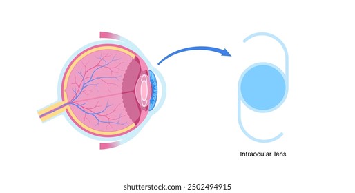 Intraocular lens implantation poster. Cataract treatment, healthy eye with IOL. Nearsightedness or farsightedness. Human visual system anatomy. Cataract surgery anatomical flat vector illustration.