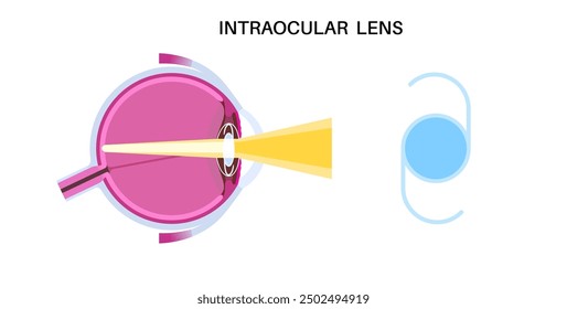 Intraocular lens implantation poster. Cataract treatment, healthy eye with IOL. Nearsightedness or farsightedness. Human visual system anatomy. Cataract surgery anatomical flat vector illustration.