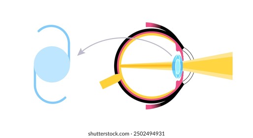 Intraocular lens implantation poster. Cataract treatment, healthy eye with IOL. Nearsightedness or farsightedness. Human visual system anatomy. Cataract surgery anatomical flat vector illustration.