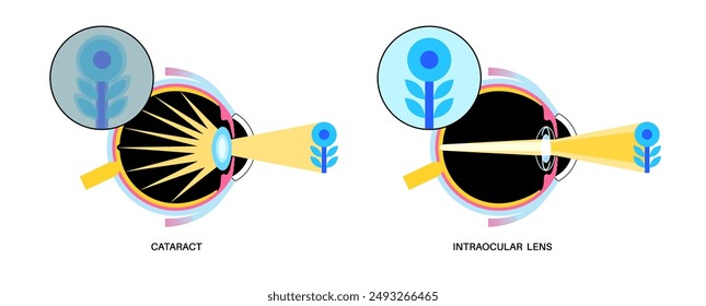 Intraocular lens implantation poster. Eye with cataract and healthy eye with IOL. Nearsightedness or farsightedness. Human visual system anatomy. Cataract surgery anatomical flat vector illustration.