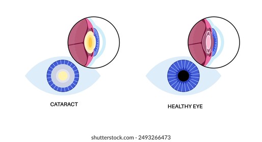 Intraocular lens implantation poster. Eye with cataract and healthy eye with IOL. Nearsightedness or farsightedness. Human visual system anatomy. Cataract surgery anatomical flat vector illustration.