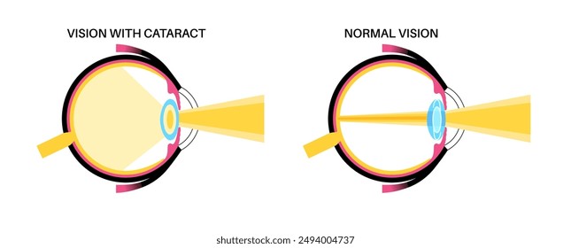 Intraocular lens implantation poster. Eye with cataract and healthy eye with IOL. Nearsightedness or farsightedness. Human visual system anatomy. Cataract surgery anatomical flat vector illustration.