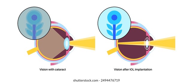 Intraocular lens implantation poster. Eye with cataract and healthy eye with IOL. Nearsightedness or farsightedness. Human visual system anatomy. Cataract surgery anatomical flat vector illustration.