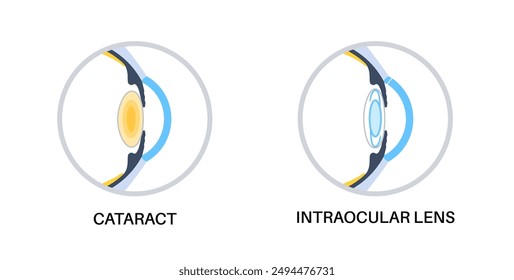 Intraocular lens implantation poster. Eye with cataract and healthy eye with IOL. Nearsightedness or farsightedness. Human visual system anatomy. Cataract surgery anatomical flat vector illustration.