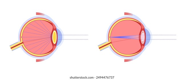 Intraocular lens implantation poster. Eye with cataract and healthy eye with IOL. Nearsightedness or farsightedness. Human visual system anatomy. Cataract surgery anatomical flat vector illustration.