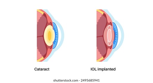 Intraocular lens implantation poster. Eye with cataract and healthy eye with IOL. Nearsightedness or farsightedness. Human visual system anatomy. Cataract surgery anatomical flat vector illustration.
