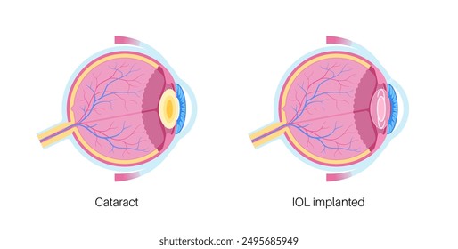 Intraocular lens implantation poster. Eye with cataract and healthy eye with IOL. Nearsightedness or farsightedness. Human visual system anatomy. Cataract surgery anatomical flat vector illustration.