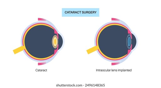 Intraocular lens implantation poster. Eye with cataract and healthy eye with IOL. Nearsightedness or farsightedness. Human visual system anatomy. Cataract surgery anatomical flat vector illustration.