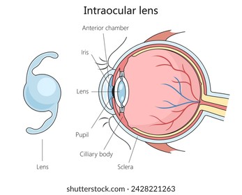 Strukturdiagramm der intraokularen Linse, handgezeichnete schematische Vektorgrafik. Medizin-Bildungs-Illustration