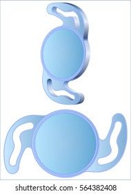 Intraocular lenses: (IOLs) are medical devices that are implanted inside the eye to replace the eye's natural lens when it is removed during cataract surgery. 