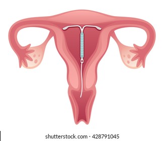 Intrauterine Device 