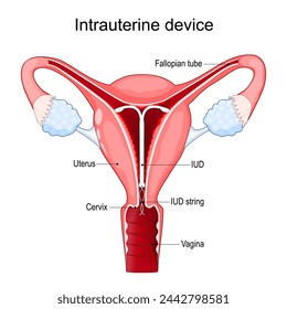 Intrauterine Vorrichtung oder Spirale. Intrauterine Empfängnisverhütungsvorrichtung zur Empfängnisverhütung. Querschnitt eines menschlichen Uterus mit IUCD oder ICD im Inneren. Vektorgrafik