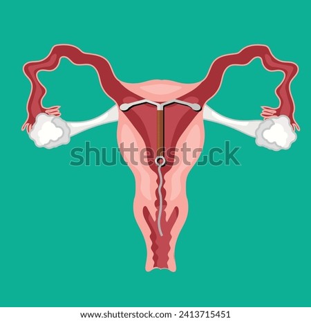 Intrauterine device inserted in uterus
