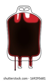 An intravenous IV drip fluid bag filled with blood. 