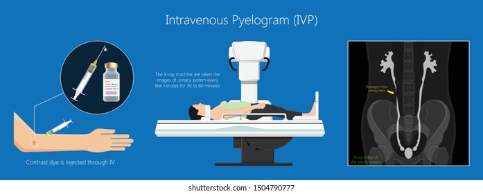 Intravenous pyelogram IVP exam diagnose treat ionizing symptom urine CT scan excretory urogram urologist urethra problem diagnostic blocked