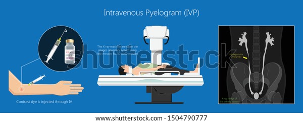 Intravenous Pyelogram IVP Exam Diagnose Treat Ionizing Symptom Urine CT ...