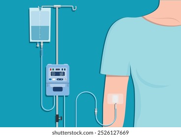 Intravenous therapy or IV therapy is a medical technique that administers fluids, medications and nutrients directly into a vein.Medical Infusion Pump IV Intravenous,Intermittent infusion, vector