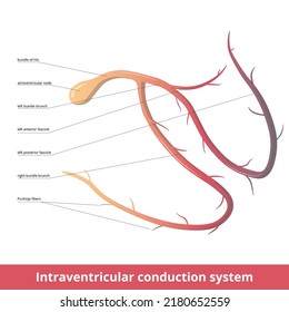 Intraventricular (electrical) Conduction System Of The Heart Transmits Signals Generated By The Sinoatrial Node To Cause Contraction Of Muscle:  Atrioventricular Node, Purkinje Fibers, Bundle Of His