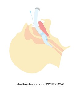 Intubation with laryngeal mask illustration. LMA positioning