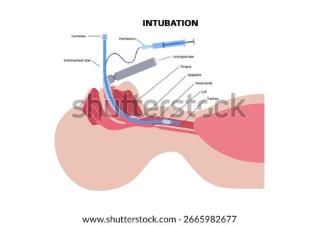 Intubation medical procedure. involving the insertion of a tube into the trachea to secure the airway, facilitate ventilation, and deliver oxygen. Using a laryngoscope to visualize the vocal cords