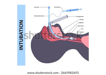 Intubation medical procedure. involving the insertion of a tube into the trachea to secure the airway, facilitate ventilation, and deliver oxygen. Using a laryngoscope to visualize the vocal cords
