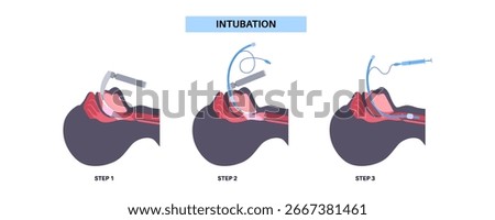 Intubation medical procedure. involving the insertion of a tube into the trachea to secure the airway, facilitate ventilation, and deliver oxygen. Using a laryngoscope to visualize the vocal cords