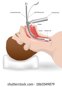 Intubation For A Patient With Respiratory Arrest Or Difficulty In Breathing