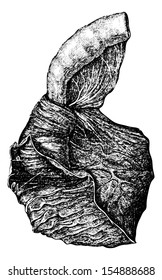 Intussusception of the Intestine, vintage engraved illustration. Usual Medicine Dictionary by Dr Labarthe - 1885