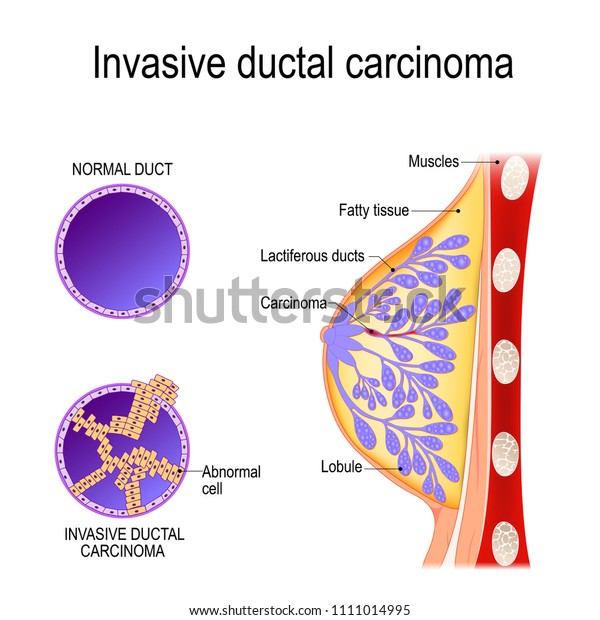 Invasive Ductal Carcinoma Crosssection Scheme Mammary Stock Vector ...