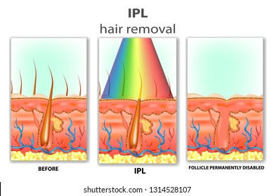 IPL (Intense Pulsed Light). How IPL Hair Removal Works