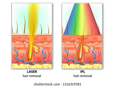 IPL (Intense Pulsed Light) and Laser Hair Removal. Hair Removal Differences