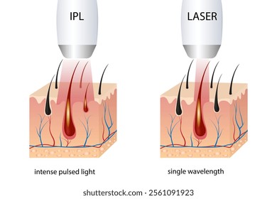 IPL (Intense Pulsed Light) and Laser Hair Removal. Differences in Hair Removal, Skin Conditions During Treatment Session