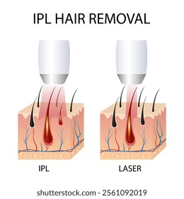 IPL (Intense Pulsed Light) and Laser Hair Removal. Differences in Hair Removal, Skin Conditions During Treatment Session