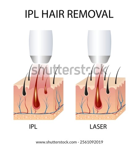 IPL (Intense Pulsed Light) and Laser Hair Removal. Differences in Hair Removal, Skin Conditions During Treatment Session