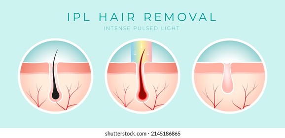 IPL Laser hair removal verctor illustration concept svg