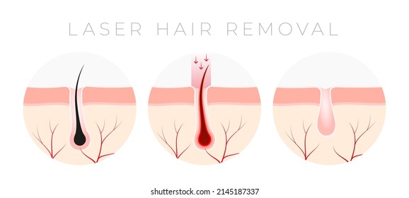 IPL Laser hair removal verctor illustration concept svg