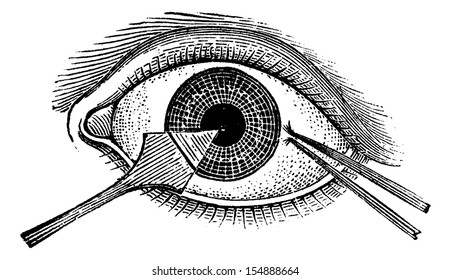 Iridectomy, using the Desmarres procedure, vintage engraved illustration. Usual Medicine Dictionary by Dr Labarthe - 1885