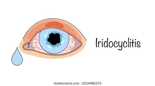 Iridociclitis. Inflamación del iris y del cuerpo ciliar del globo ocular. La enfermedad se acompaña de lagrimeo y cambios en el iris. Ilustración vectorial sobre oftalmología.