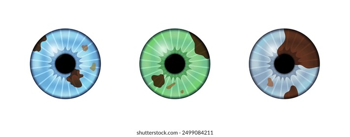 Iris melanoma poster. Surgical iridectomy procedure. Defect of vision, primary neoplasm. Glaucoma, cataract and melanoma laser treatment. Surgical removal of part human eye flat vector illustration.