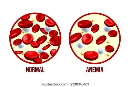 Iron deficiency anemia.The difference of Anemia amount of red blood cell and normal. Vector Medical illustration isolated on white background
