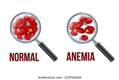 Iron deficiency anemia.The difference of Anemia amount of red blood cell and normal. Vector Medical illustration isolated on white background