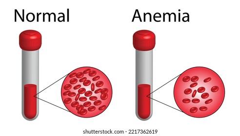 Anemia por deficiencia de hierro. La diferencia entre la cantidad de anemia de glóbulos rojos y la normalidad. Imagen vectorial 3d realista. Ilustración del vector aislada en fondo blanco