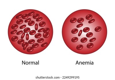Iron deficiency anemia. The difference of Anemia amount of red blood cell and normal. Blood droplet. Blood donation. Realistic vector 3d picture. Vector illustration isolated on white background.
