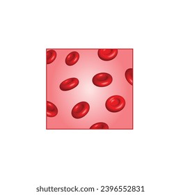 Anemia por deficiencia de hierro. La diferencia entre la cantidad de anemia de glóbulos rojos y la normalidad. Gotas de sangre. Donación de sangre. Imagen vectorial 3d realista. Ilustración vectorial aislada en fondo blanco.