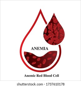 Iron deficiency anemia difference of  cell and normal symptoms vector illustration medical.
