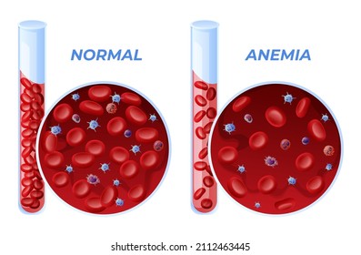 Iron deficiency anemia and normal set vector illustration. Collection difference of amount of red blood cell medical diagram test tube and microscopic structure isolated. Medicine genetic illness