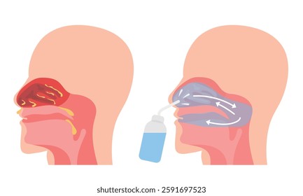 Irrigation of nasal passages. Relief and treatment from allergies, reducing inflammation, cleaning the nasal passages, hydration, improvement of nasal function