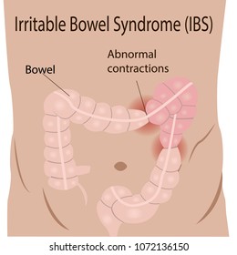 Irritable Bowel Syndrome (IBS) In A Large Intestine Vector Illustration